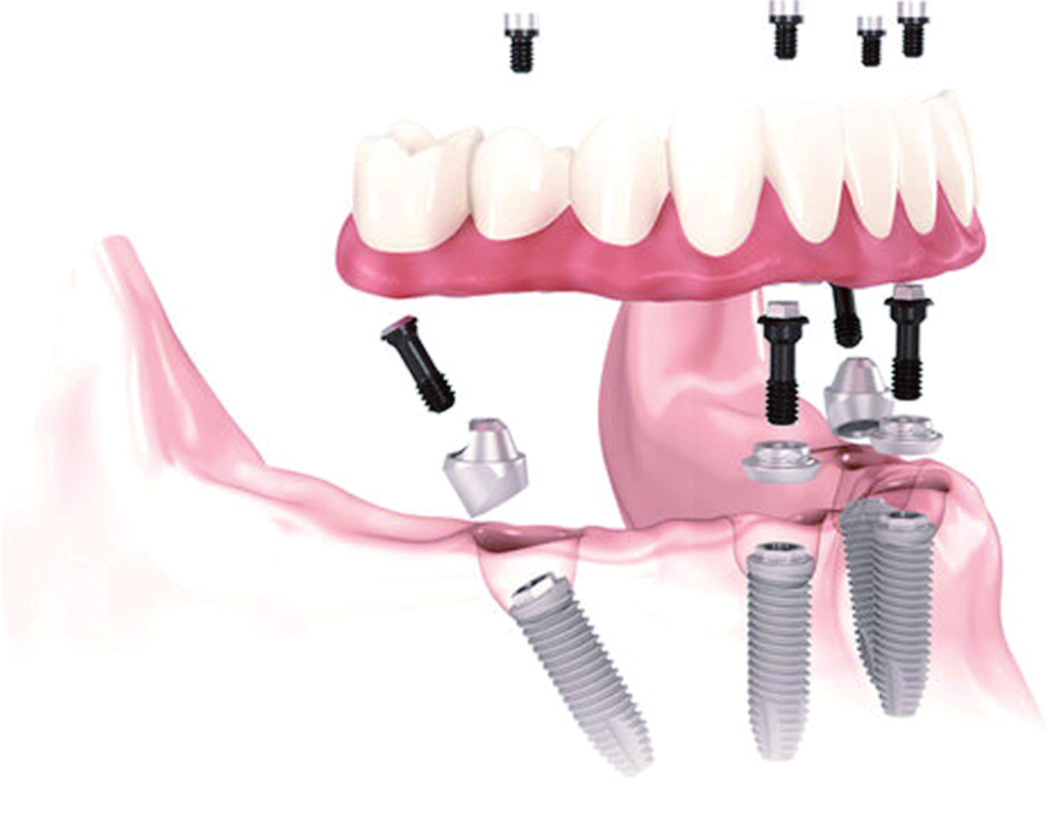     种4颗修复半口牙示意图。