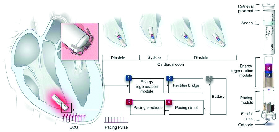     共生型自供电无导线心脏起搏器示意图。新华社发